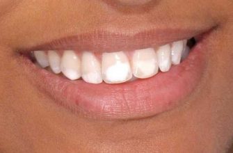 Белые пятна на зубах: причины возникновения и способы лечения